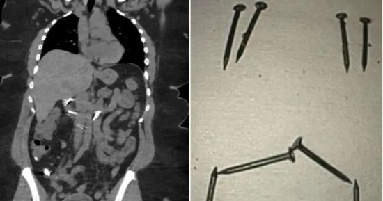 «قصة مؤثرة من داخل الأمعاء» بسبب اضطراب بيكا.. استخراج 8 مسامير ضخمة من أمعاء امرأة بريطانية